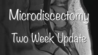 Microdiscectomy Recovery  2 Weeks [upl. by Hyozo]