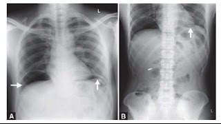 Perforated Viscus Part 2 [upl. by Uzia]