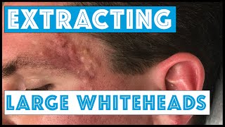 Acne Vulgaris and Extracting large Whiteheads  Part 1 [upl. by Tavis]