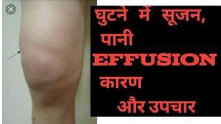 Swelling  edema effusion in Knee joint Hindi  घुटने में पानी भरना सूजन का इलाज knee pain ACL [upl. by Ahsonek]