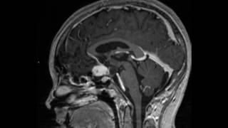 Optic nerve glioma [upl. by Dammahom733]