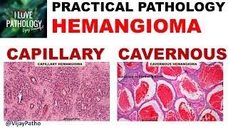 HEMANGIOMA capillary amp Cavernous Clinical features amp Morphology [upl. by Mcmahon616]