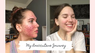 Roaccutane  My 6 Month Journey to Clear Skin [upl. by Obelia]