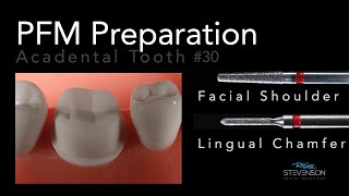 PFM Preparation  Acadental Tooth 30  Dr Richard Stevenson [upl. by Leoj332]