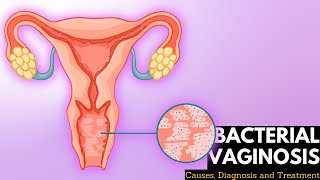 Bacterial vaginosis Causes Signs and Symptoms DIagnosis and Treatment [upl. by Ribak]