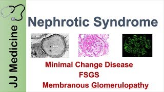 Acute Nephritic Syndrome Fundamentals – Nephrotic Syndrome  Lecturio [upl. by Akcired]