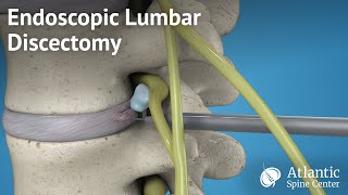 Endoscopic Lumbar Discectomy [upl. by Enyala879]