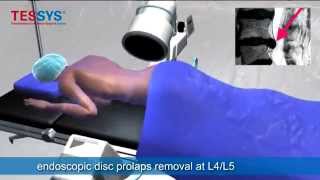 Endoscopic Microdiscectomy at Arizona Pain Treatment Centers [upl. by Curry106]