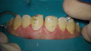 diastema closure with ceramic veneer [upl. by Neilson584]