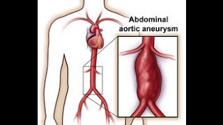 Abdominal Aortic Aneurysm AAA [upl. by Esylla]