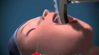 Artificial Airways amp Intubation [upl. by Hally681]