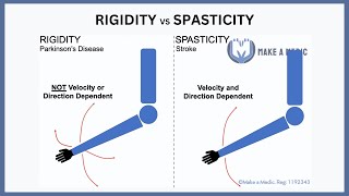 Spastic dysarthria  samples and tutorial [upl. by Elum]