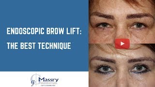 Brow lift with Botox or Dysport [upl. by Markowitz]