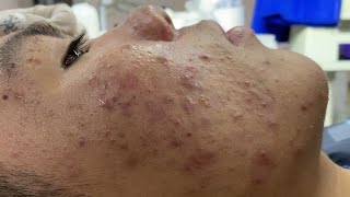 Blackheads Removal at Duyên An 0128 [upl. by Aldous]