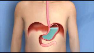 HYPER ACIDITY Tips and Remedies  Dr Willie Ong Health Blog 24b [upl. by Geibel733]