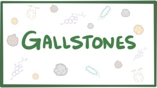 Gallstones cholelithiasis [upl. by Breena]