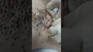 Nevus Comedonicus removal [upl. by Thorin]