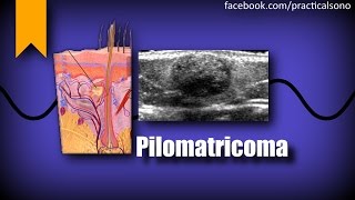 Pilomatricoma [upl. by Gnay]