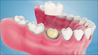 Dental Crown Procedure [upl. by Jaimie]