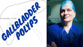 Sonoquickies  Gallbladder Polyps [upl. by Nnylarac]