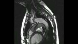 Patent ductus arteriosus on echocardiography [upl. by Minnaminnie]