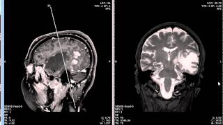 Homonymous hemianopsia caused by tumor [upl. by Kirsch]