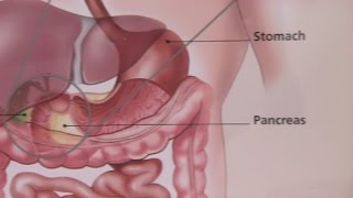 Pediatric Intussusception Emergency Bowel Obstruction [upl. by Korten]