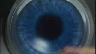 Z LASIK How Bladeless Eye Surgery Works [upl. by Nosredneh]