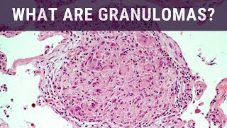 What are Granulomas  Pathology mini tutorial [upl. by Corrinne]