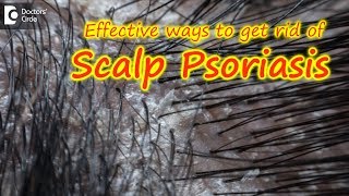 Scalp psoriasisSymptom Cause Treatment  Safe ways to Wash Hair Dr Rasya Dixit Doctors Circle [upl. by Atilek]