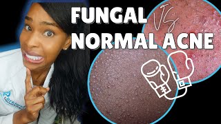 FUNGAL ACNE vs NORMAL ACNE [upl. by Kassity187]