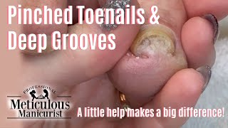 Pedicure Thick Pinched Toenails Satisfying Before and After [upl. by Magnus351]