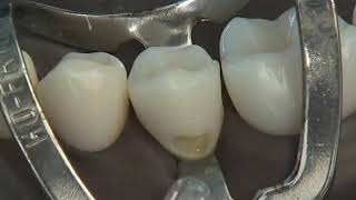 Class V Composite Preparation amp Restoration  Operative Dentistry [upl. by Scriven]