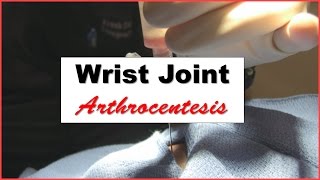 Wrist Joint Arthrocentesis Procedure [upl. by Aeet]