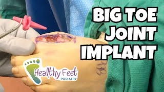 Big Toe Joint Implant for Pain and Arthritis [upl. by Tekcirk]