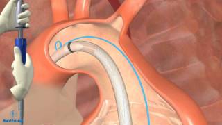 Aneurisma de la aorta abdominal en particular infrarrenal [upl. by Ruford714]