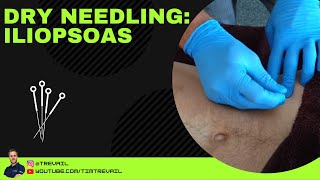 Dry Needling Iliopsoas [upl. by Hgielrak]