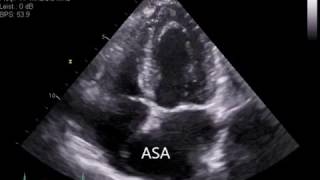 Atrial Septal Aneurysm ASA [upl. by Dnumyar]