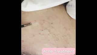 Comedone Extraction Acne Treatment [upl. by Negiam]