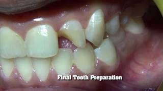 Fibre reinforced composite restoration with lingual matrix technique [upl. by Sandie504]