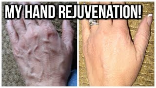 💝 HOW TO TREAT HAND VEINS 💝 [upl. by Inihor]