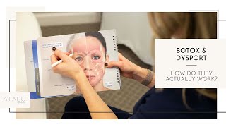 Botox Injections from low eyebrows lifting them up  by Dr Kassir [upl. by Philana]