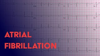 Atrial Fibrillation Afib  EKG ECG Interpretation [upl. by Nevin136]