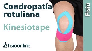 Kinesiotape para la condropatia o condromalacia rotuliana [upl. by Darlene]