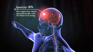 Types of cerebral palsy [upl. by Sigfried115]