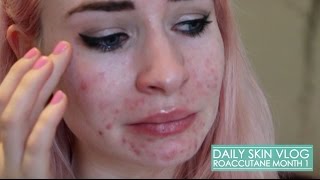 Roaccutane Daily Skin Vlog  Month 1 [upl. by Caressa335]