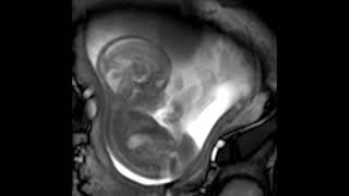 MRI scan at 21 weeks [upl. by Perni]