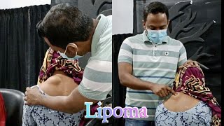 Lipoma  surgery  bangla [upl. by Islehc]