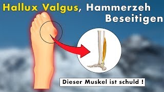 3 Übungen gegen Hallux Valgus Hammerzeh Ballenzeh  Die WAHRE Ursache amp Lösung [upl. by Louella]