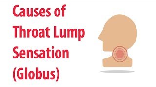 Causes of Throat Lump Sensation Globus [upl. by Haik]